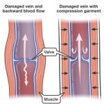 2019 06 07 compression garments damaged veins en